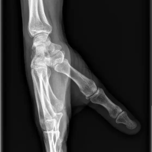 Radiographie du poignet