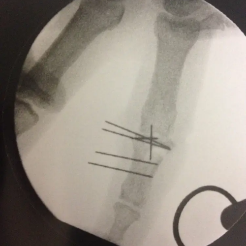 Fracture de phalange post opératoire stabilisation par broche