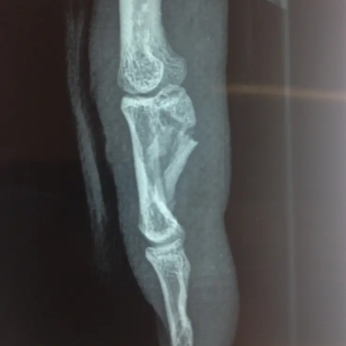 Radiographie fracture de phalange pré opératoire