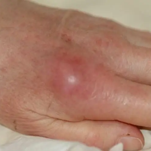 Arthrite