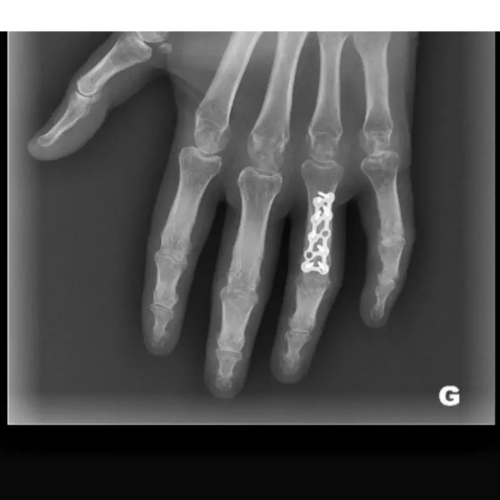 Radiographie ostéosynthèse fracture de phalange